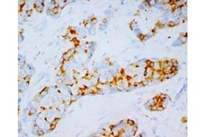 Immunohistochemical analysis of paraffin embedded Mammary cancer sections, staining ITGA4 in cytoplasm, DAB chromogenic reaction