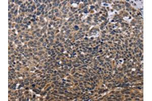The image is immunohistochemistry of paraffin-embedded Human cervical cancer tissue using ABIN7129566(GADD45A Antibody) at dilution 1/30. (GADD45A anticorps)