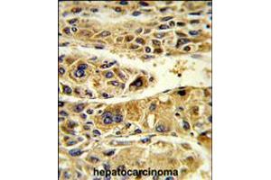 Formalin-fixed and paraffin-embedded human hepatocarcinoma reacted with ADH6 Antibody , which was peroxidase-conjugated to the secondary antibody, followed by DAB staining. (ADH6 anticorps  (AA 209-240))