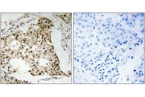 Immunohistochemistry analysis of paraffin-embedded human breast carcinoma, using Retinoic Acid Receptor alpha (Phospho-Ser77) Antibody. (Retinoic Acid Receptor alpha anticorps  (pSer77))