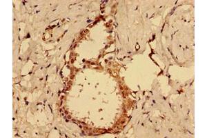 Immunohistochemistry of paraffin-embedded human ovarian cancer using ABIN7164435 at dilution of 1:100 (MKRN2 anticorps  (AA 29-170))