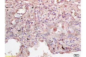 Formalin-fixed and paraffin embedded human lung tissue labeled with Rabbit Anti-IL-2R gamma Polyclonal Antibody  at 1:200 followed by conjugation to the secondary antibody and DAB staining.