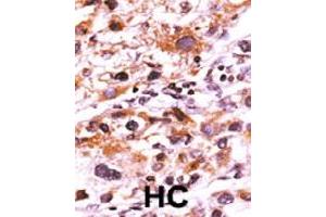 Formalin-fixed and paraffin-embedded human hepatocellular carcinoma tissue reacted with FGFR1 (phospho Y766) polyclonal antibody  which was peroxidase-conjugated to the secondary antibody followed by AEC staining. (FGFR1 anticorps  (pTyr766))