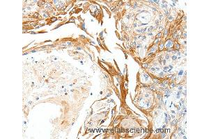 Immunohistochemistry of Human esophagus cancer using PLAT Polyclonal Antibody at dilution of 1:50 (PLAT anticorps)