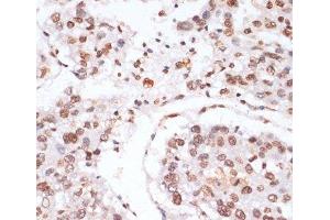 Immunohistochemistry of paraffin-embedded Human liver cancer using Phospho-Stat3(Y705) Polyclonal Antibody at dilution of 1:100 (40x lens). (STAT3 anticorps  (pTyr705))