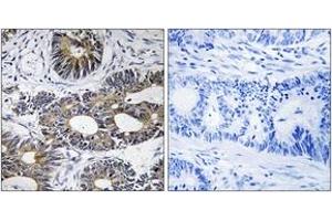 Immunohistochemistry analysis of paraffin-embedded human colon carcinoma tissue, using EIF1AY Antibody. (EIF1AY anticorps  (AA 21-70))