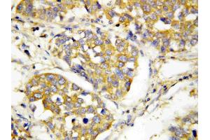 Anti-TLR4 antibody, IHC(P): Human Lung Cancer Tissue (TLR4 anticorps  (N-Term))