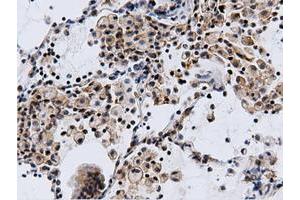 Immunohistochemical staining of paraffin-embedded Adenocarcinoma of Human breast tissue using anti-CBWD1 mouse monoclonal antibody. (CBWD1 anticorps)