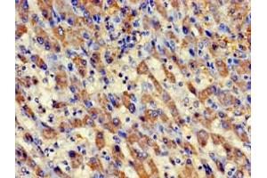 Immunohistochemistry of paraffin-embedded human liver cancer using ABIN7145083 at dilution of 1:100