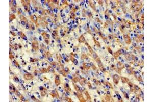 Immunohistochemistry of paraffin-embedded human liver cancer using ABIN7145083 at dilution of 1:100 (Aurora Kinase C anticorps  (AA 12-143))