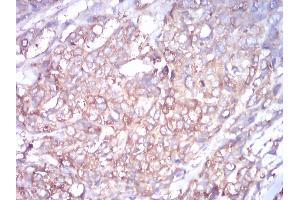 Immunohistochemical analysis of paraffin-embedded ovarian cancer tissues using TUBB1 mouse mAb with DAB staining.
