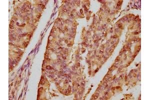 IHC image of ABIN7127552 diluted at 1:80 and staining in paraffin-embedded human endometrial cancer performed on a Leica BondTM system.