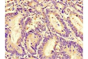 Immunohistochemistry of paraffin-embedded human colon cancer using ABIN7167611 at dilution of 1:100 (RGS4 anticorps  (AA 1-205))