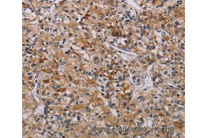 Immunohistochemistry of Human liver cancer using AATK Polyclonal Antibody at dilution of 1:45 (AATK anticorps)
