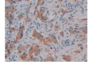 IHC-P analysis of Human Prostate Gland Cancer Tissue, with DAB staining. (Kallikrein 10 anticorps  (AA 35-276))