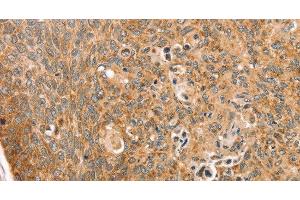 Immunohistochemistry of paraffin-embedded Human esophagus cancer using TRIM62 Polyclonal Antibody at dilution of 1:30