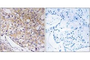 Immunohistochemistry analysis of paraffin-embedded human breast carcinoma tissue, using TRAPPC1 Antibody. (TRAPPC1 anticorps  (AA 10-59))