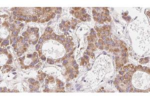 ABIN6279304 at 1/100 staining Human liver cancer tissue by IHC-P. (CLDN14 anticorps  (C-Term))