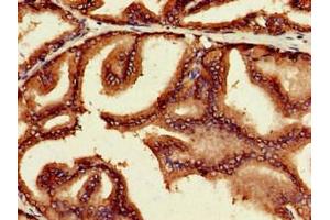 Immunohistochemistry of paraffin-embedded human prostate cancer using ABIN7160384 at dilution of 1:100