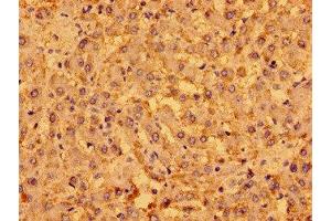 Immunohistochemistry of paraffin-embedded human liver cancer using ABIN7165807 at dilution of 1:100 (MENT (AA 24-197) anticorps)