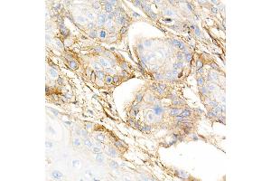 Immunohistochemistry of paraffin-embedded human esophageal cancer using Integrin-β1/CD29 Rabbit mAb (ABIN7267926) at dilution of 1:5000 (40x lens). (ITGB1 anticorps)