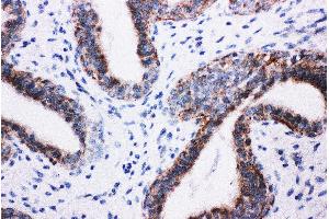 Anti-PI 3 Kinase p85 beta antibody, IHC(P) IHC(P): Human Mammary Cancer Tissue