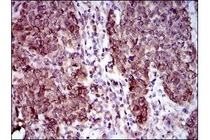 Immunohistochemical analysis of paraffin-embedded breast cancer tissues using CLGN mouse mAb with DAB staining.