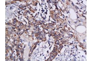Formalin-fixed and paraffin embedded human colon carcinoma labeled with Anti-DAPK1 Polyclonal Antibody, Unconjugated  at 1:200 followed by conjugation to the secondary antibody and DAB staining (DAP Kinase 1 anticorps  (AA 1331-1430))