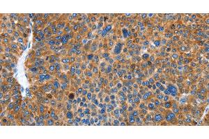 Immunohistochemistry of paraffin-embedded Human liver cancer using AUP1 Polyclonal Antibody at dilution of 1:50