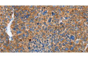 Immunohistochemistry of paraffin-embedded Human liver cancer using AUP1 Polyclonal Antibody at dilution of 1:50 (Ancient Ubiquitous Protein 1 anticorps)