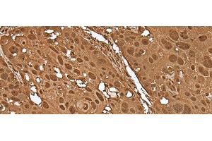 Immunohistochemistry of paraffin-embedded Human esophagus cancer tissue using VCP Polyclonal Antibody at dilution of 1:30(x200) (VCP anticorps)