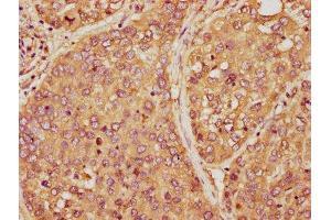 IHC image of ABIN7165036 diluted at 1:150 and staining in paraffin-embedded human liver cancer performed on a Leica BondTM system. (AMBP anticorps  (AA 20-203))