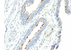 Formalin-fixed, paraffin-embedded human Colon Carcinoma stained with T-F Antigen / CD176 Mouse Monoclonal Antibody (A78-G/A7). (CD176 anticorps)