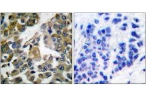 Immunohistochemistry analysis of paraffin-embedded human breast carcinoma tissue, using PLCG1 (Ab-783) Antibody. (Phospholipase C gamma 1 anticorps  (AA 751-800))