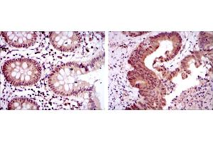 Immunohistochemical analysis of paraffin-embedded colon tissues (left) and colon cancer tissues (right) using OTX2 mouse mAb with DAB staining. (OTX2 anticorps)