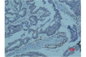 Immunohistochemical analysis of paraffin-embedded human colon caricnoma using Survivin Monoclonal Antibody. (Survivin anticorps)