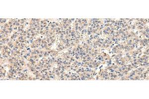 Immunohistochemistry of paraffin-embedded Human liver cancer tissue using VPS45 Polyclonal Antibody at dilution 1:50 (VPS45 anticorps)
