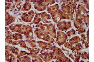 IHC image of ABIN7142134 diluted at 1:300 and staining in paraffin-embedded human pancreatic cancer performed on a Leica BondTM system.