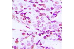 Immunohistochemical analysis of hnRNP G staining in human breast cancer formalin fixed paraffin embedded tissue section. (RBMX anticorps  (N-Term))