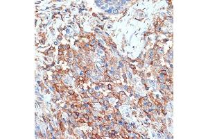 Immunohistochemistry of paraffin-embedded human breast cancer using Phospholipid Phospholipid Scramblase 1 (PLSCR1) (PLSCR1) Rabbit mAb (ABIN7269354) at dilution of 1:100 (40x lens). (PLSCR1 anticorps)