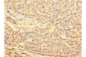 Immunohistochemistry of paraffin-embedded human ovarian cancer using ABIN7166432 at dilution of 1:100