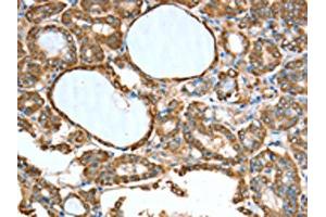 The image on the left is immunohistochemistry of paraffin-embedded Human thyroid cancer tissue using ABIN7189774(ALDH9A1 Antibody) at dilution 1/50, on the right is treated with synthetic peptide. (ALDH9A1 anticorps)