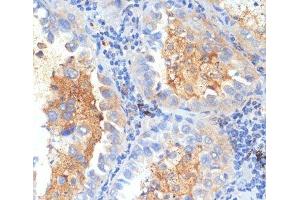 Immunohistochemistry of paraffin-embedded Human lung cancer using SEMA4C Polyclonal Antibody at dilution of 1:100 (40x lens).