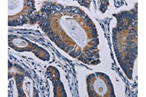 The image on the left is immunohistochemistry of paraffin-embedded Human colon cancer tissue using ABIN7191806(PCDHAC2 Antibody) at dilution 1/50, on the right is treated with synthetic peptide. (PCDHAC2 anticorps)