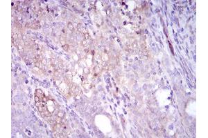 Immunohistochemical analysis of paraffin-embedded cervical cancer tissues using SQSTM1 mouse mAb with DAB staining.