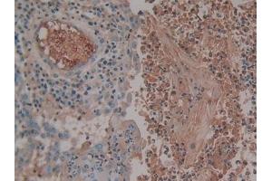 Detection of AT in Human Skin cancer Tissue using Monoclonal Antibody to Antithrombin (AT)