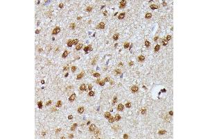 Immunohistochemistry of paraffin-embedded human esophageal cancer using KI Rabbit pAb (ABIN7269712) at dilution of 1:250 (40x lens). (Protein Virilizer Homolog (VIRMA) (AA 1400-1700) anticorps)