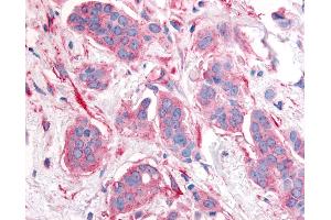Anti-ERBB2 / HER2 antibody IHC of human breast carcinoma, neoplastic cells. (ErbB2/Her2 anticorps  (Cytoplasmic Domain))