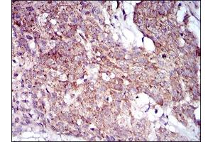 Immunohistochemical analysis of paraffin-embedded esophageal cancer tissues using MRPL42 mouse mAb with DAB staining. (MRPL42 anticorps  (AA 142-203))