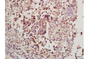 Formalin-fixed and paraffin embedded rat lung carcinoma labeled with Anti-phospho-P70 S6 Kinase beta (Thr228) Polyclonal Antibody, Unconjugated (ABIN732608) at 1:200, followed by conjugation to the secondary antibody and DAB staining (RPS6KB2 anticorps  (pThr228))